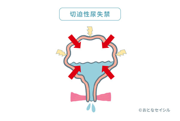 切迫性尿失禁のメカニズムを解説した図