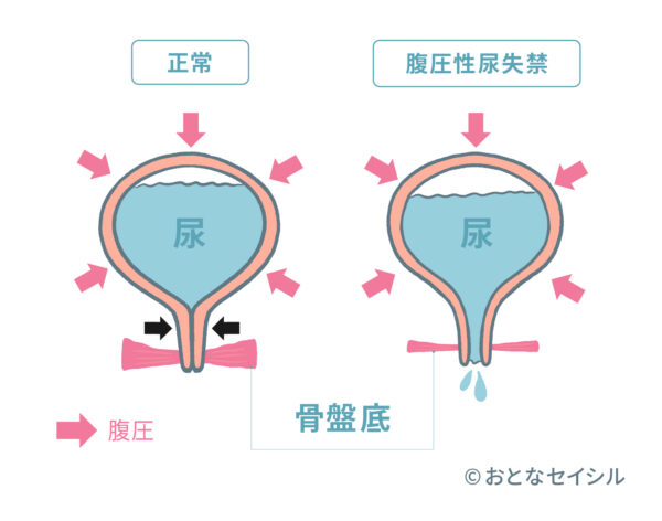 腹圧性尿失禁が起こるメカニズムを解説した図