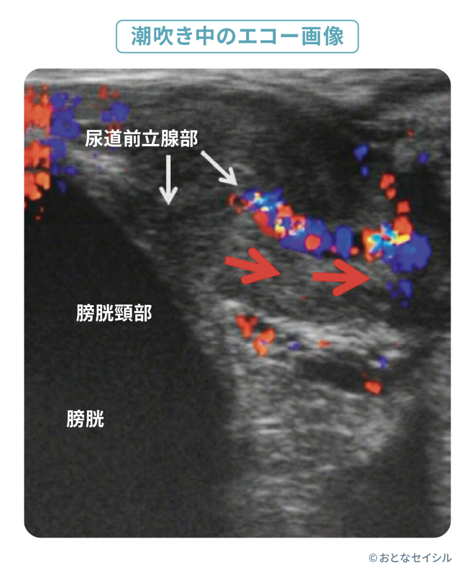 潮吹き　エコー画像