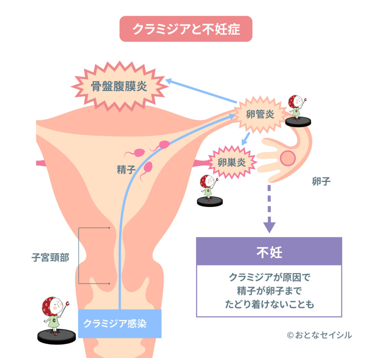 クラミジアと不妊症に関する画像