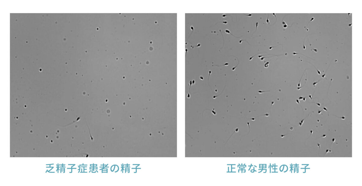 乏精子症と正常な男性の精子の比較画像