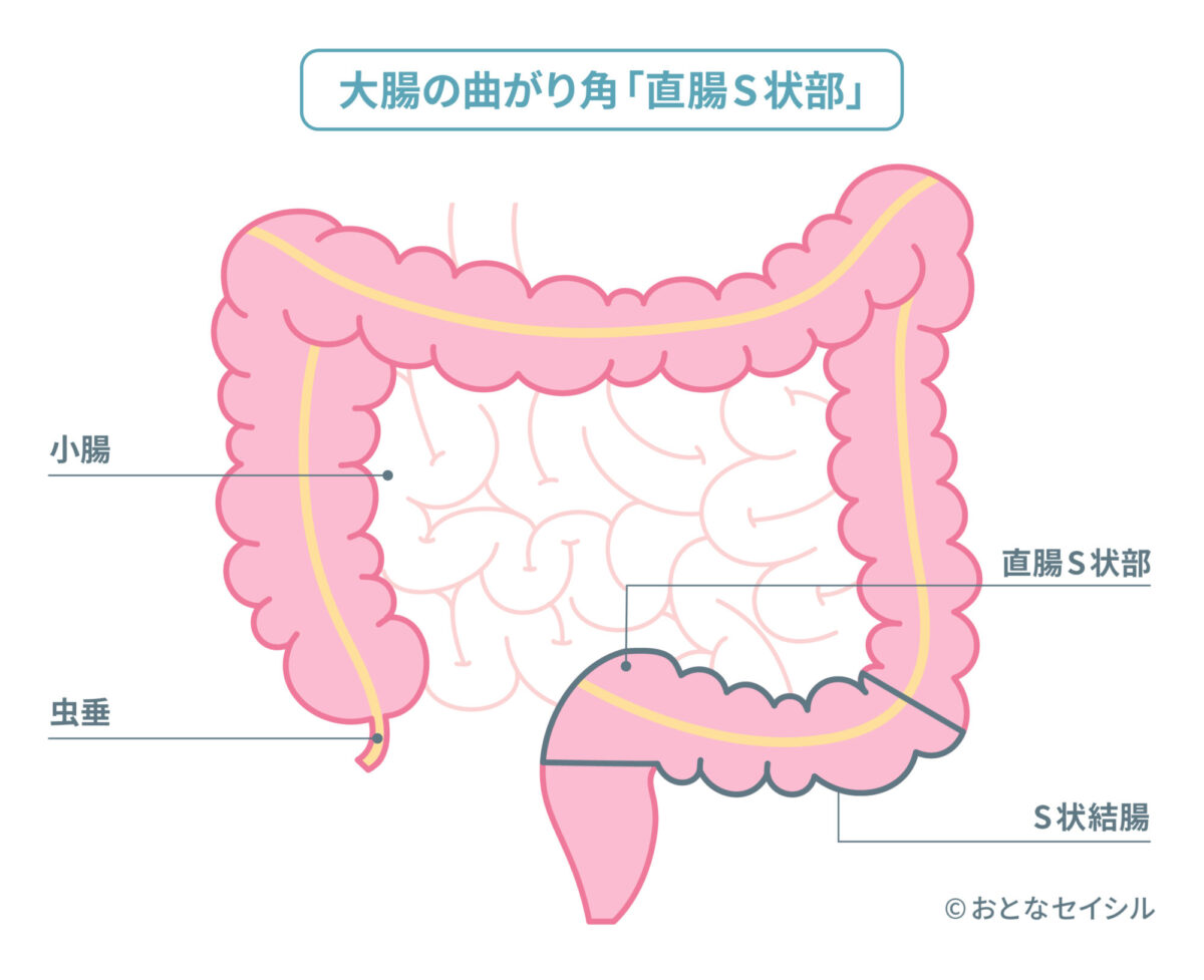 大腸の曲がり角　直腸S状部の画像